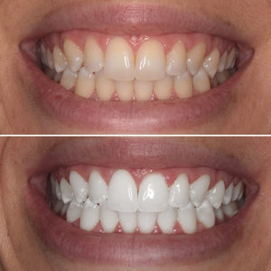 Teeth Whitening Dentist Cost.jpg
